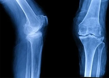 Osteoarthritis Relief Carlsbad, CA